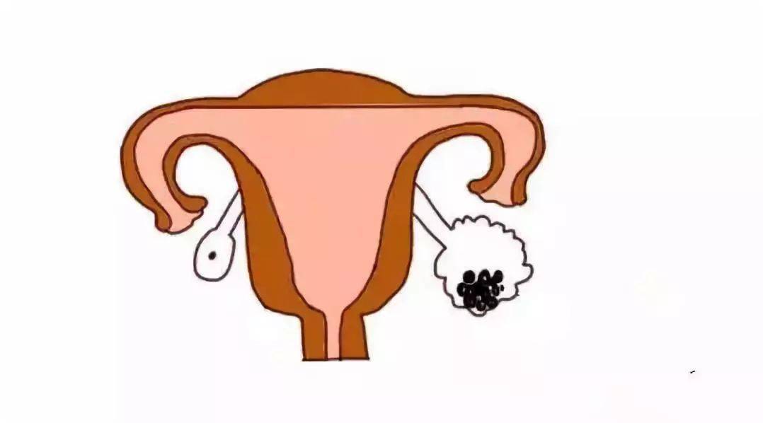 多囊卵巢综合征多见于育龄期女性,临床上以排卵功能紊乱和高雄激素