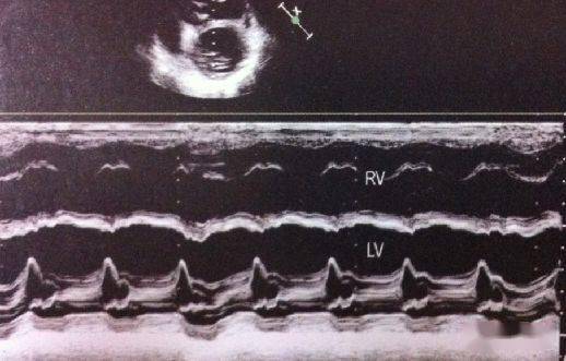 限制型心肌病与缩窄性心包炎的超声鉴别_心室