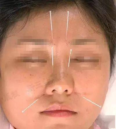 干货靳三针30组穴位图文并茂