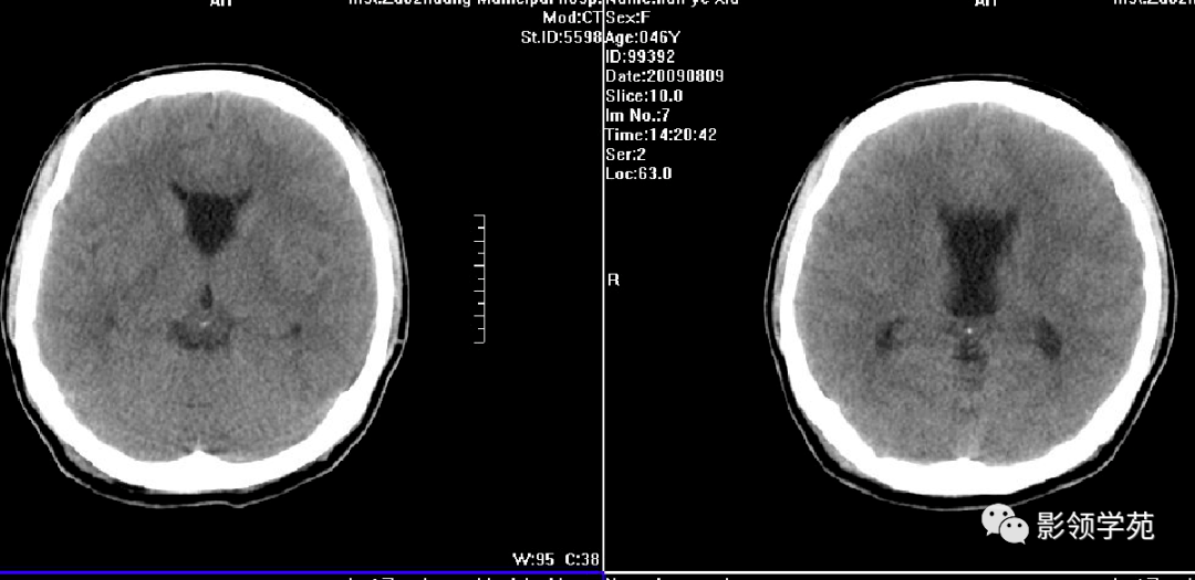 外囊ct图片图片