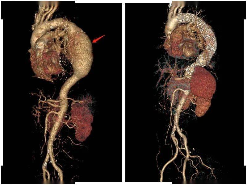 主动脉窦瘤图片图片