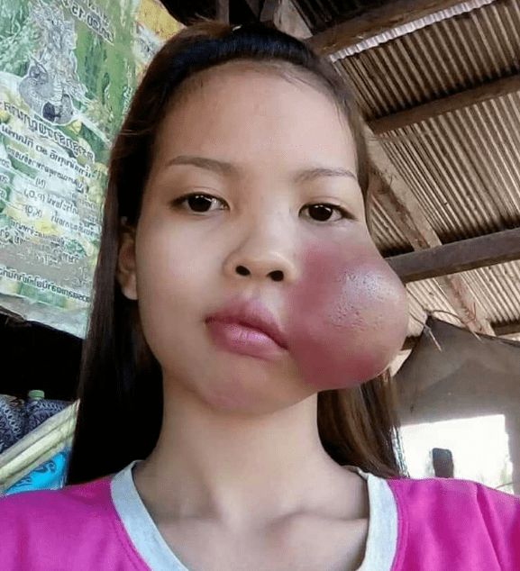 柬埔寨美女罹怪病左脸冒巨型肿瘤全国医生都束手无策