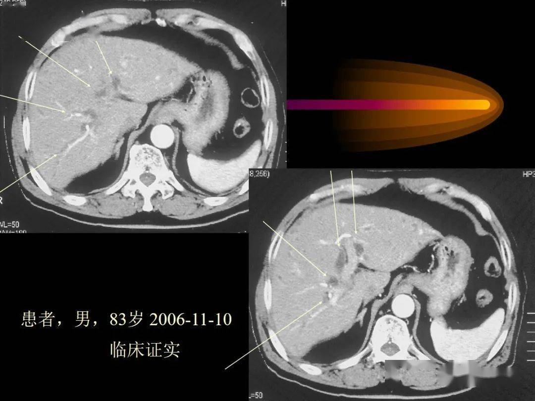 肝内周围型胆管细胞癌的影像特征