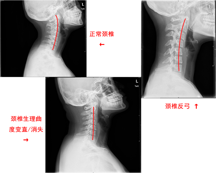 颈椎正常形态图片