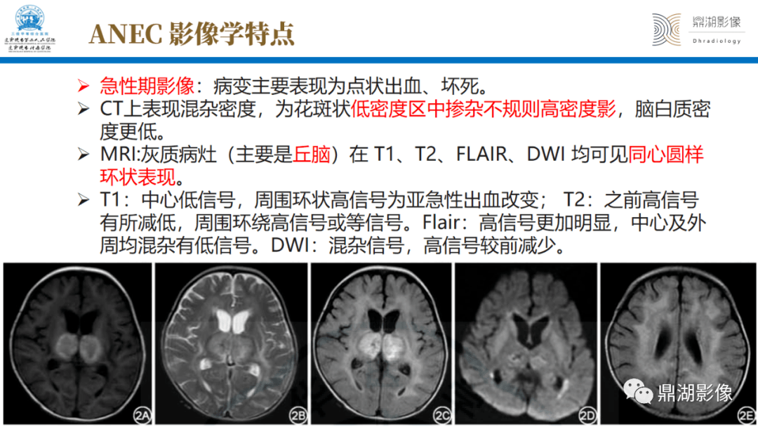 文献学习儿童急性坏死性脑病anec