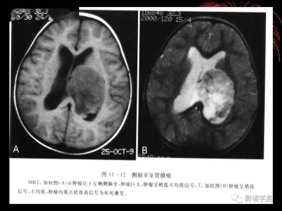 側腦室佔位影像鑑別診斷