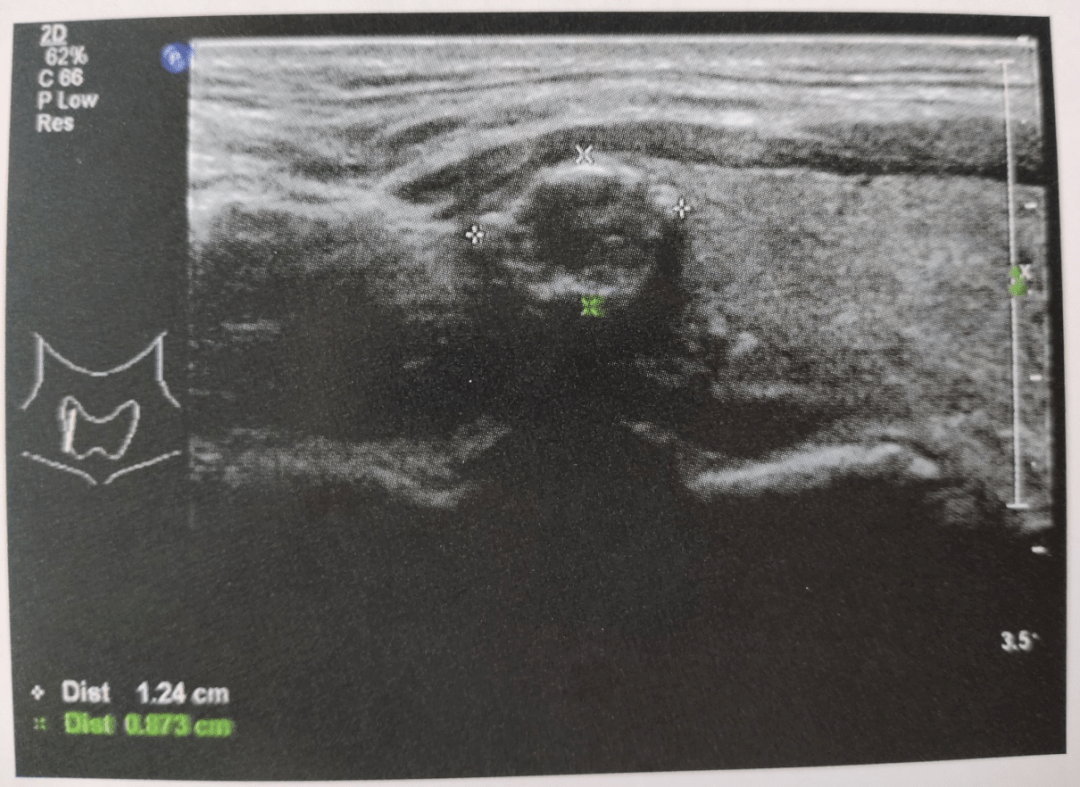 香醫科普丨超聲顯示甲狀腺不同類型鈣化