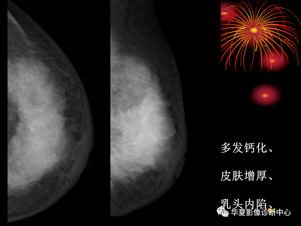 乳腺數字化鉬靶x線診斷的臨床應用