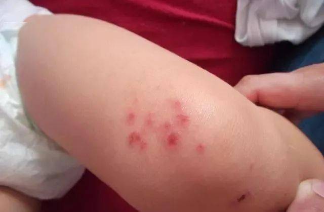 这是日常生活中很常见的一种皮肤病,其特点就是皮肤瘙痒,会出现小红