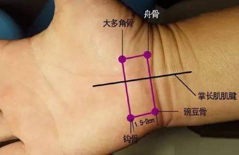 针刀治疗腕管综合征图文详解