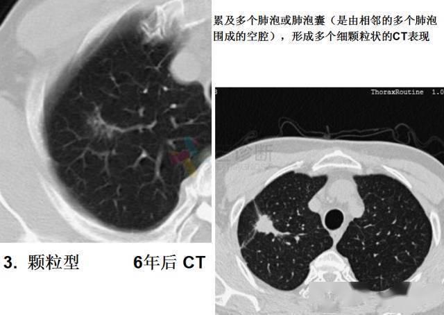 乾貨收藏丨微小肺癌的ct形態學分型