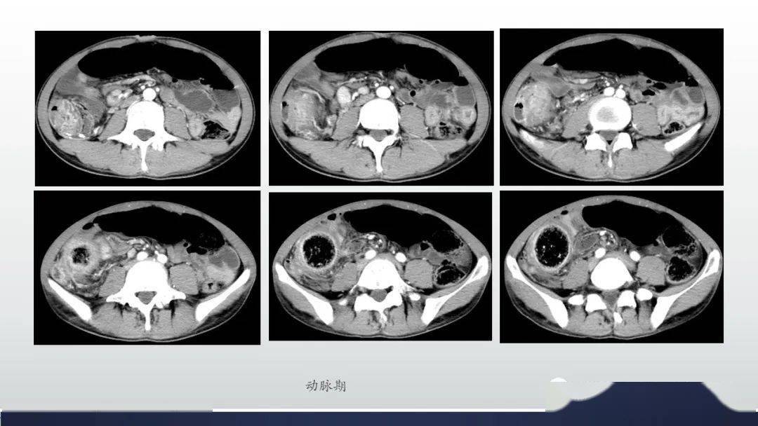 肠管丨克罗恩病