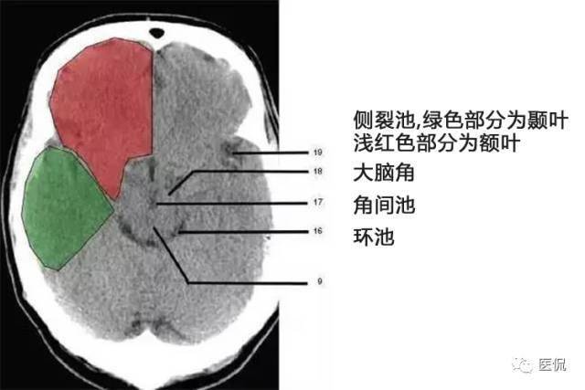 顱腦ct解剖口訣及彩色解剖圖