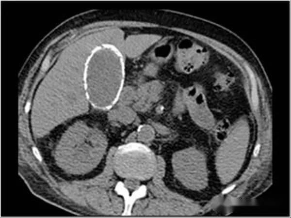 典型图片瓷胆囊