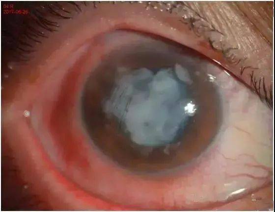 电击伤,放射线损伤,尖锐物品刺伤,穿透性眼内异物所引起的白内障