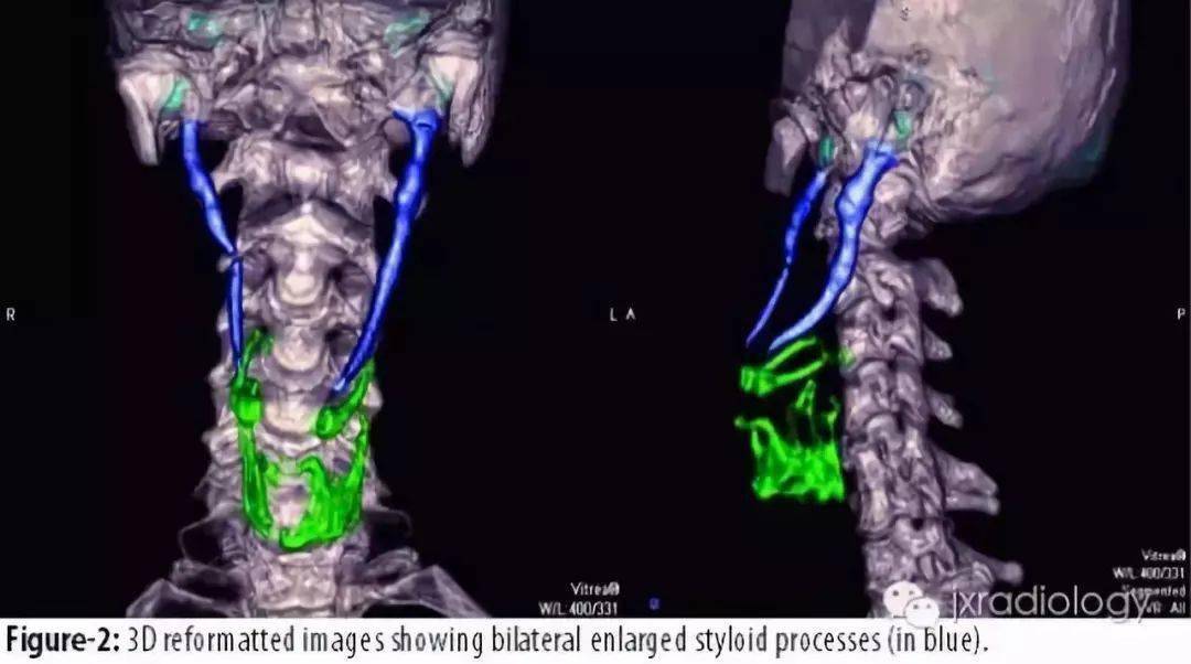 舌骨韧带骨化而引起的一系列症状称为 茎突过长综合征或茎突综合征