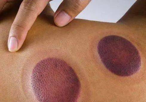 拔火罐时皮肤留下的黑紫色印记真的是在排出体内毒素吗