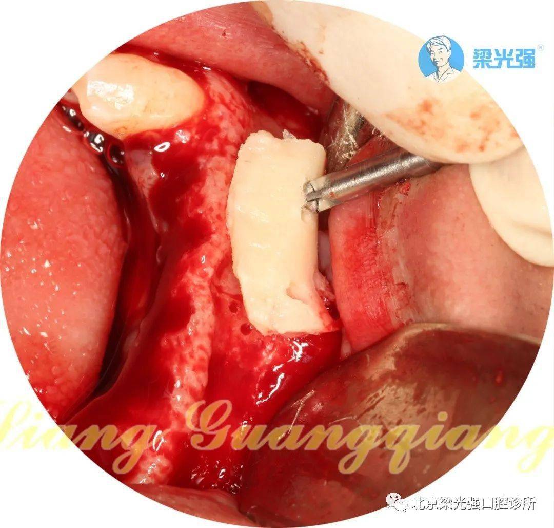 牙医学堂难度高度升级自体骨块移植