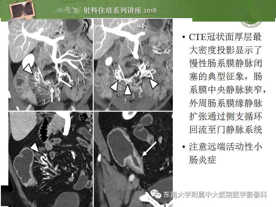 粘膜下固有層增厚伴慢性炎症細胞浸潤,隱窩結構扭曲,隱窩炎,隱窩膿腫