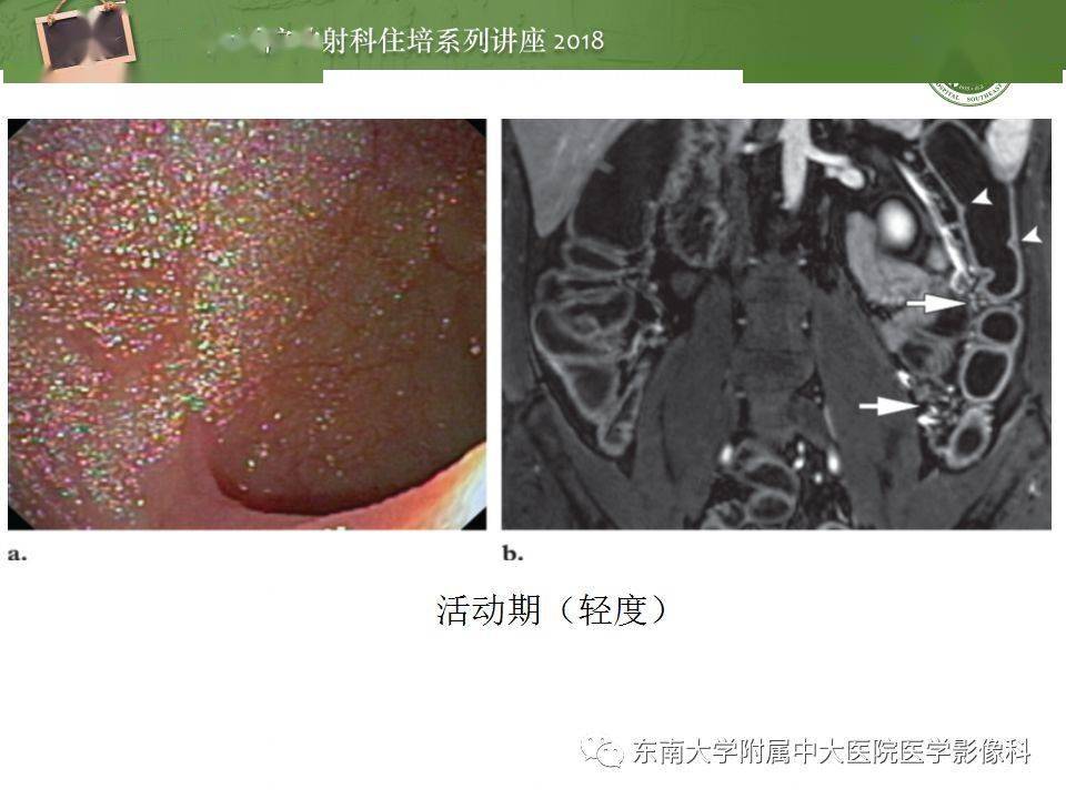 炎症性肠病的影像诊断与评价