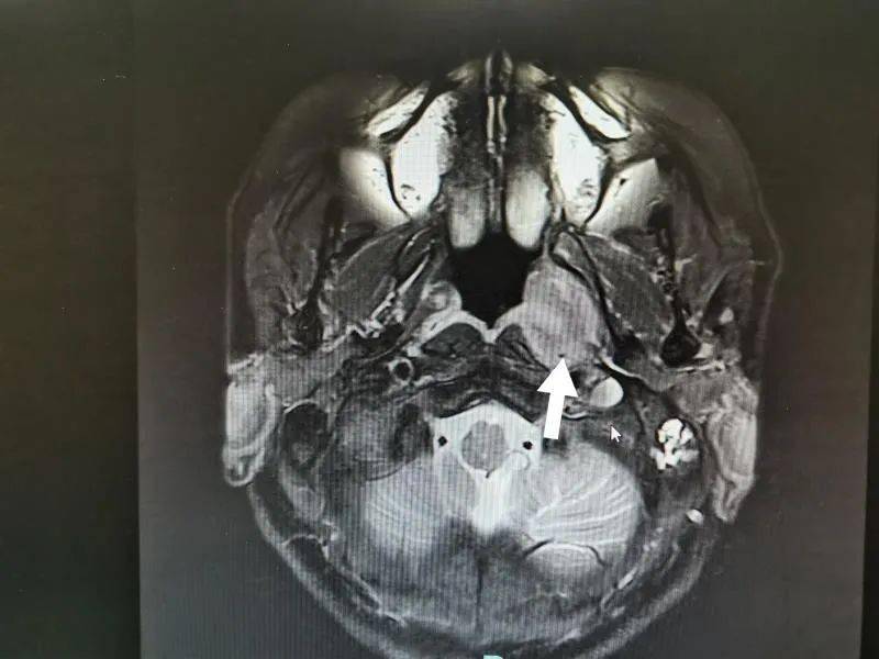 做了鼻咽ct发现左侧鼻咽占位,增强鼻咽mri结果也显示她得了鼻咽癌