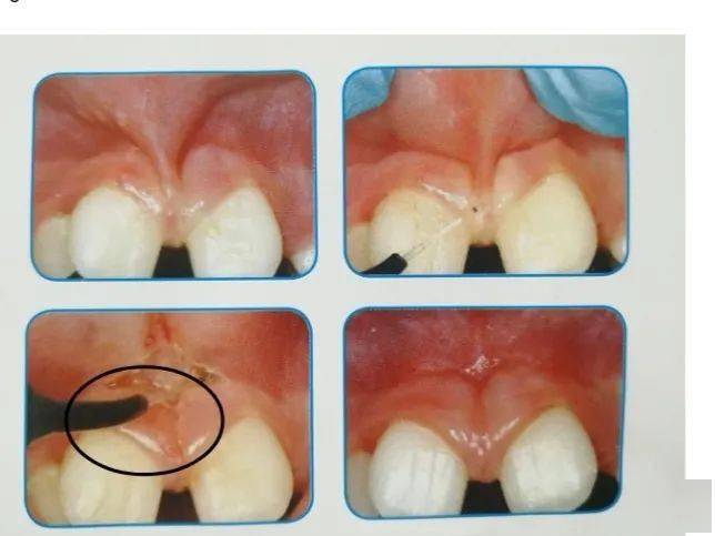 包括唇舌系带矫正术,种植牙二期手术,牙龈手术(牙龈切除,牙龈修形)