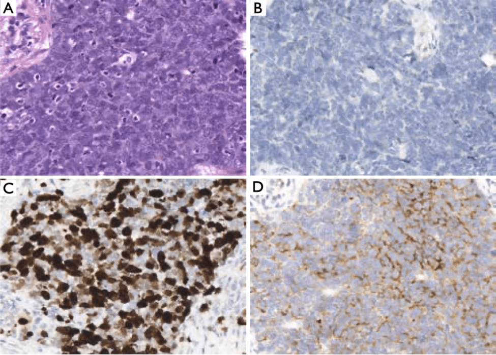 肺神经内分泌肿瘤_细胞