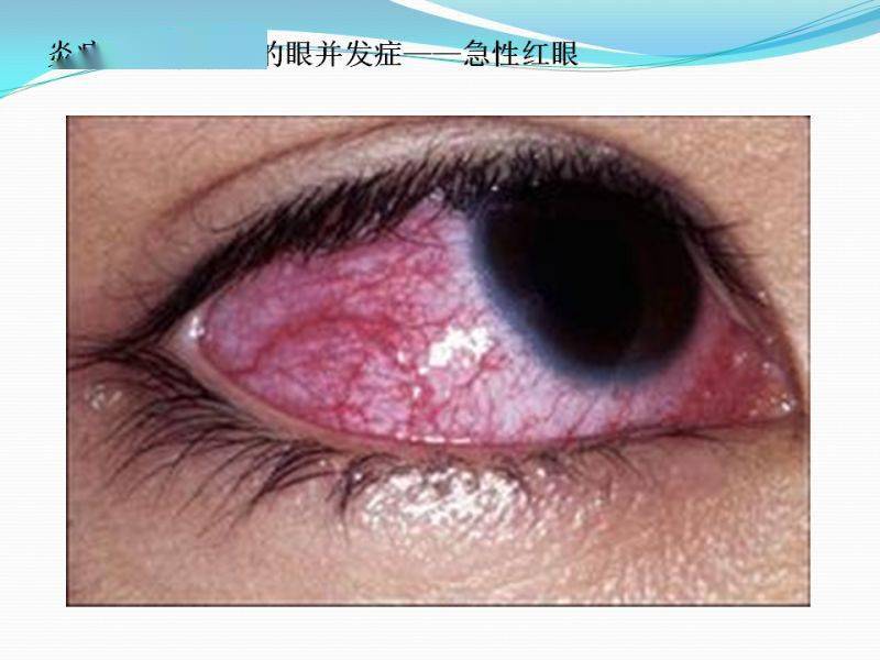 眼视光隐形眼镜的并发症