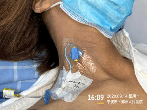 颈外静脉输液法图片