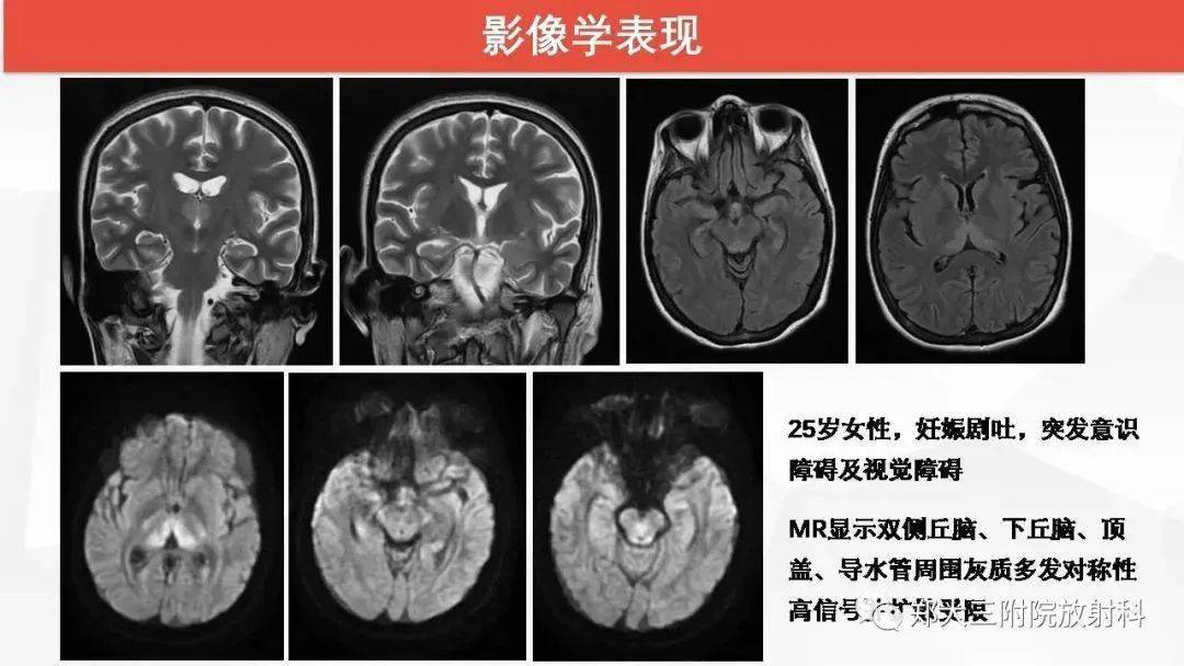 wernicke脑病的影像诊断