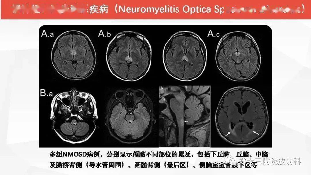 wernicke脑病的影像诊断