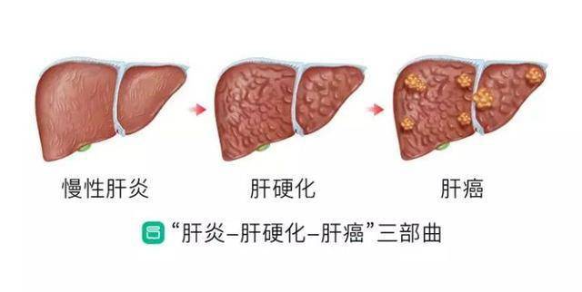 換肝重生中國肝癌患者的終極選擇