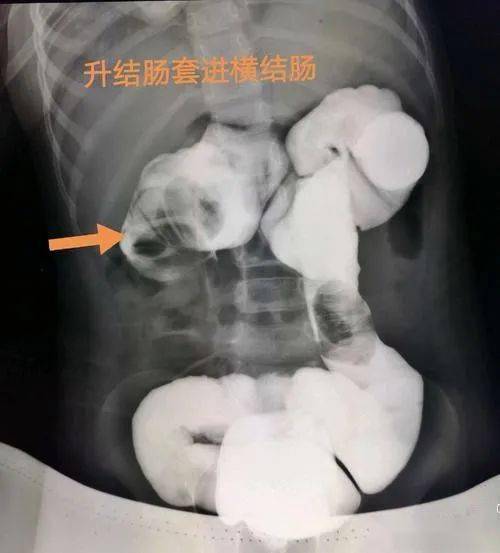 肠套叠图片腹部图片