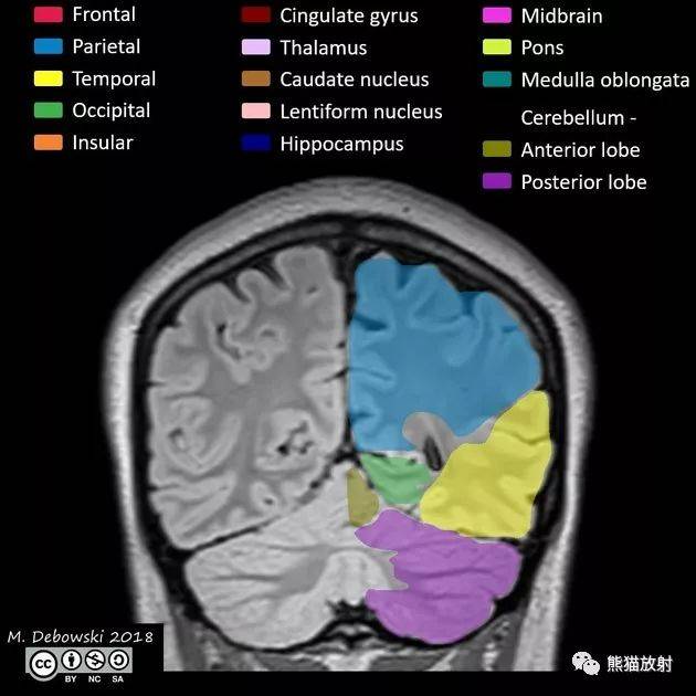 解剖丨脑叶分布(MRI图像彩色标注)_lobes