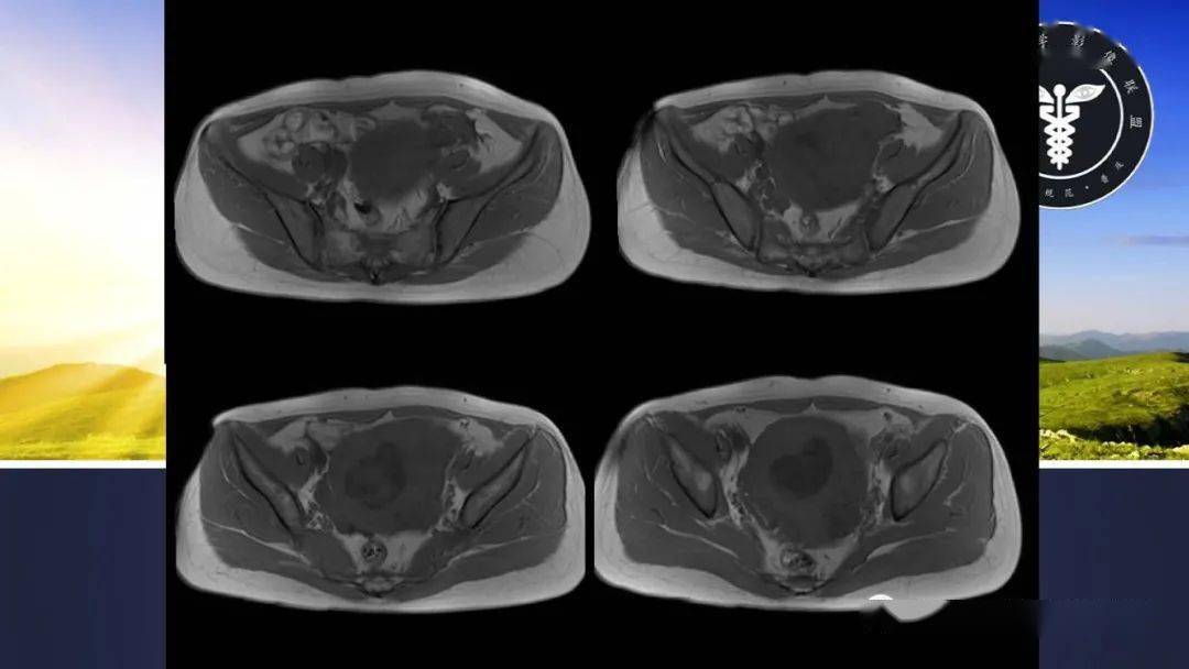 子宫平滑肌瘤CT图片