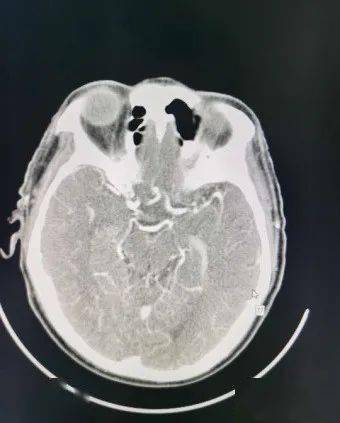 头颈部cta具有很强的时间和空间的分辨率,而且具有强大的图像后处理