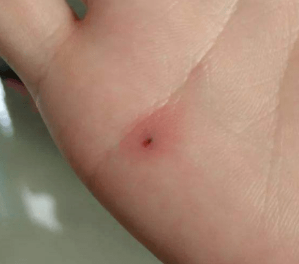 铅笔芯不小心扎进手里除了清创消毒还要打针