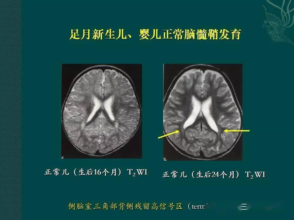 郑大三附院放射科 朱功升《足月儿及婴儿正常脑发育的影像学表现》