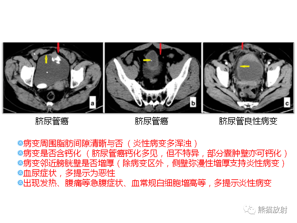 脐尿管脓肿↓ 相关内容链接:【专题】脐尿管畸形与脐尿管癌的ct表现