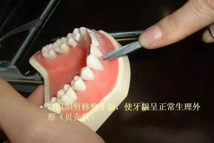 牙医必备技能之松牙固定术