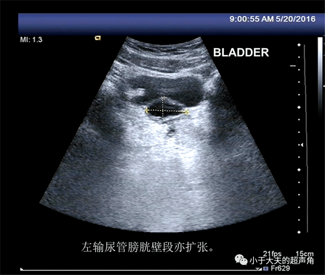 【超聲隨響】第21期 腎臟先天性發育異常 診斷腎缺如要謹慎!