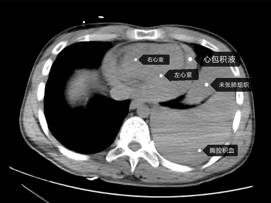 心包脂肪垫ct图片