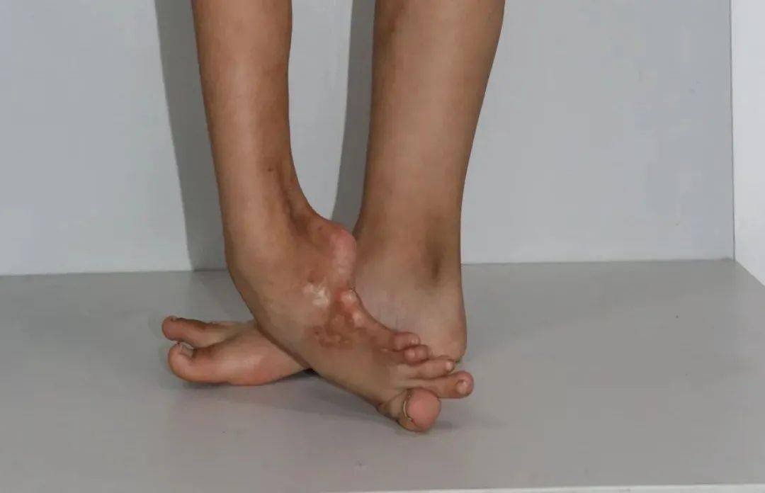手外科/足踝外科每年都会进行几十例该类复杂畸形矫正手术
