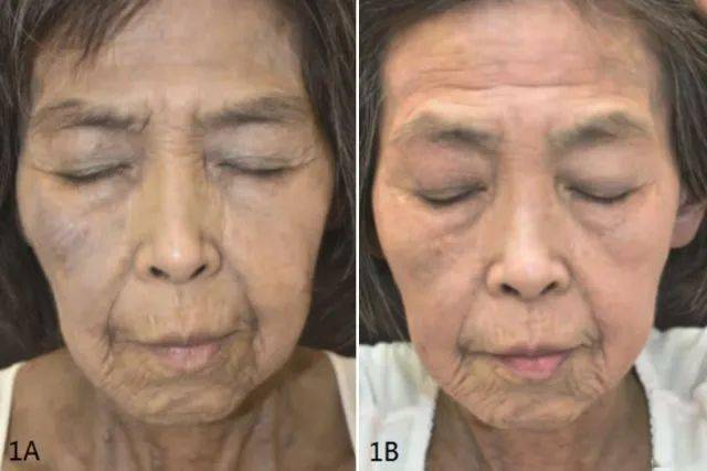 面部,躯干,四肢蓝灰色色素沉着,黏膜未累及(见图 1a),既往史:高血压