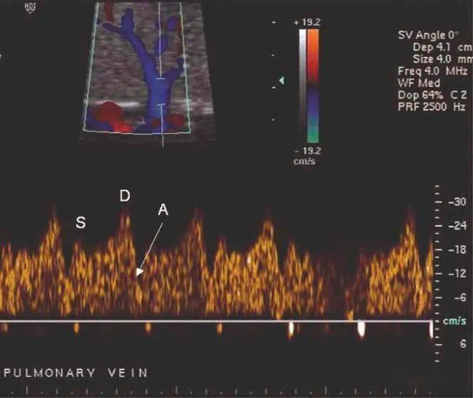 正常肺动脉血流频谱图图片