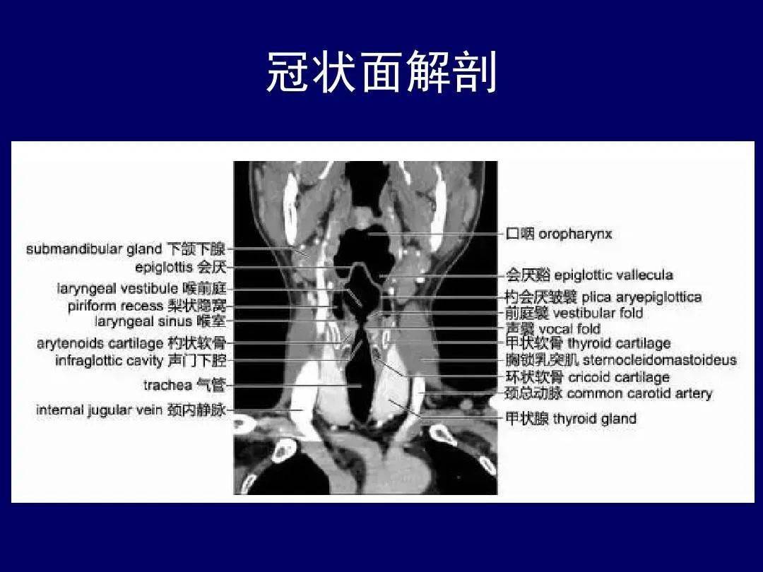 梨状窝ct解剖图片