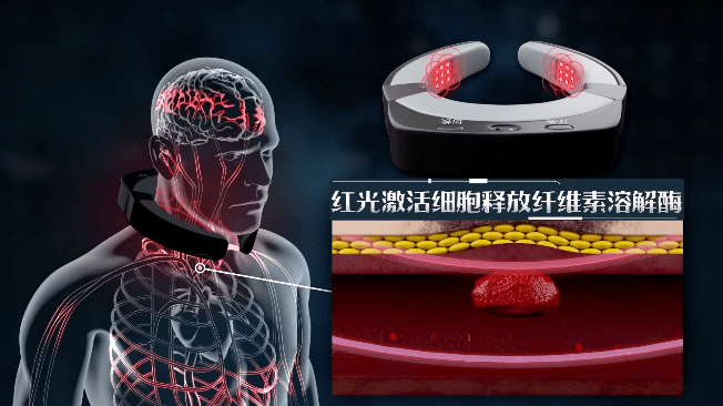 体外化斑溶栓 战胜高血压 实现化斑溶栓 的世纪突破 -红蓝光治疗仪的