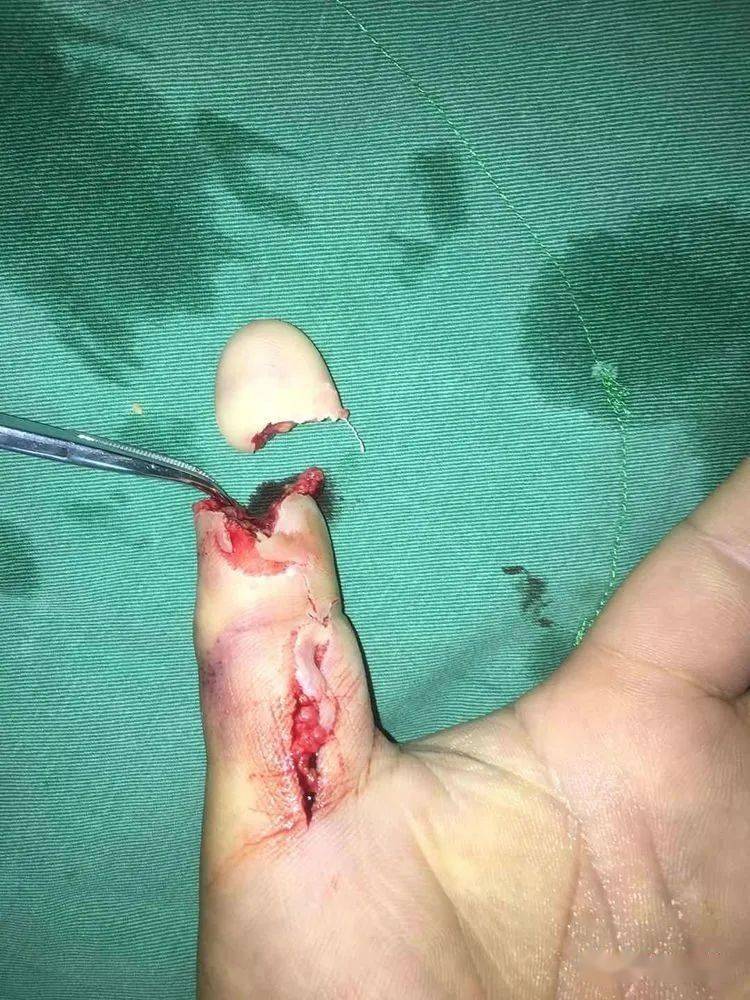 术中所见术中探查见:离断指体血管抽出并有血栓形成!术中竭尽全力!