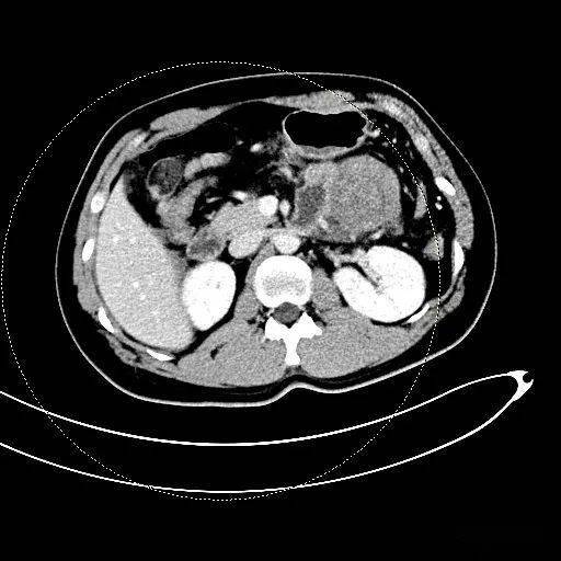 胰腺腺泡细胞癌