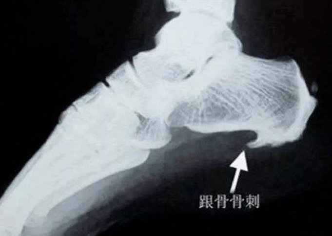 骨刺是一根刺吗关节疼痛大多跟骨刺有关这些锅骨刺不背